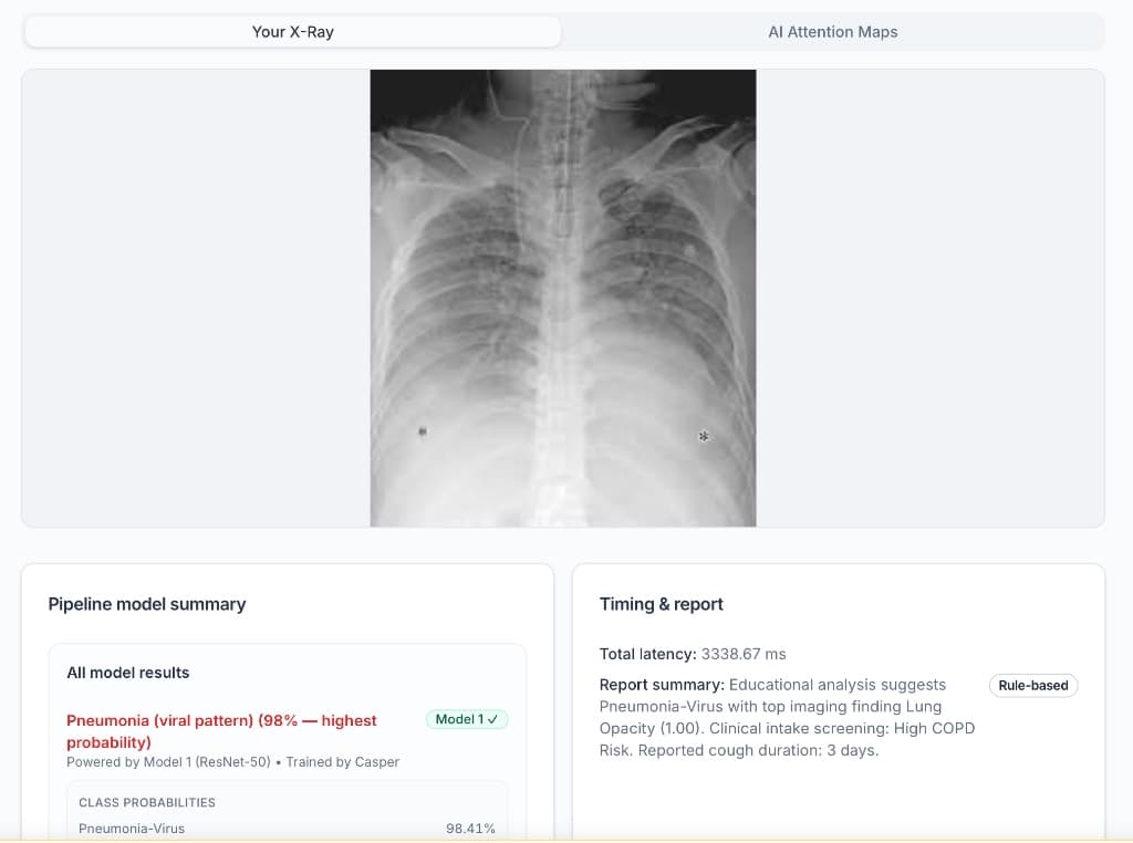 LungLens results view — chest X-ray with AI attention maps and pipeline model summary showing pneumonia analysis